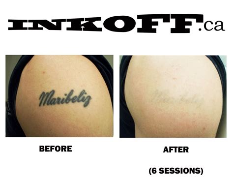 Laser Tattoo Removal Pain Management - Second Skin Tattoo