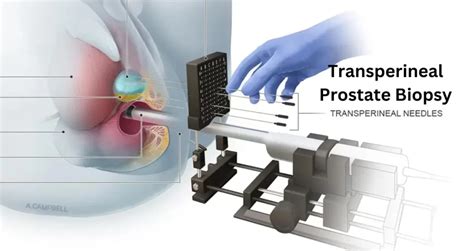 What Is a Transperineal Prostate Biopsy? Revealing the Procedure, Recovery, and Benefits