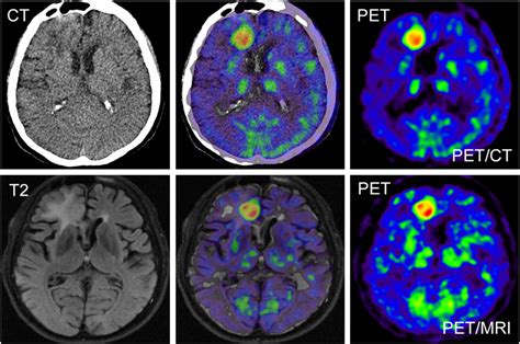 PET/CT and PET/MRI images of 56-y-old patient with glioblastoma... | Download Scientific Diagram