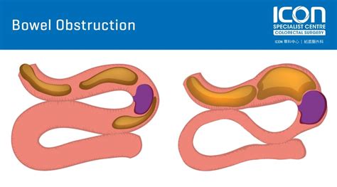 Bowel obstruction — Icon Specialist Centre