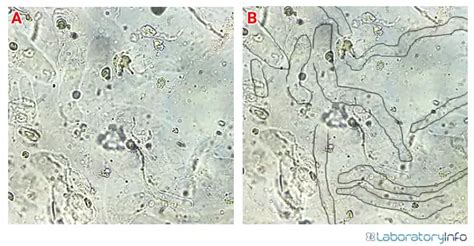 Hyaline Casts in Urine - Causes, Normal range and High levels ...