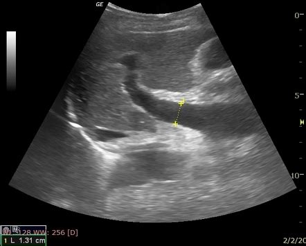 Idiopathic portal hypertension | Radiology Reference Article ...