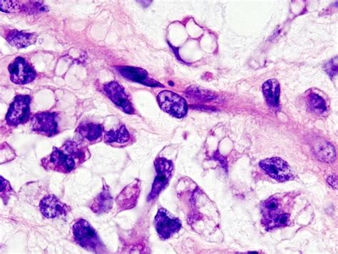 Myxoid liposarcoma (06) - Liposarcoma in 2020 | Tissue types, Sarcoma ...