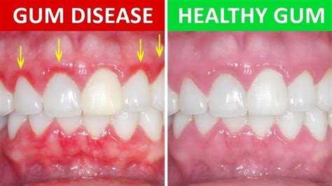 Everything You Need to Know About Gum Disease - South Trail Crossing Dental