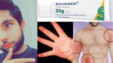 Dermazin/Silver Sulfadiazine Cream uses side effects.treatment for ...