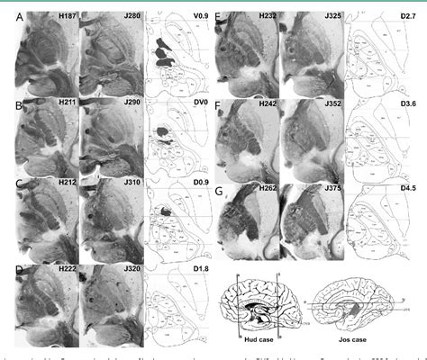 Figure 1 from Dejerine-Roussy syndrome | Semantic Scholar