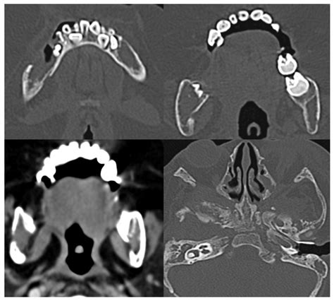 Axial CT scan images with bone window; (a,b,d): and soft tissue; (c ...