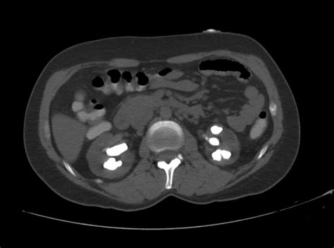 Kidney stone CT - wikidoc