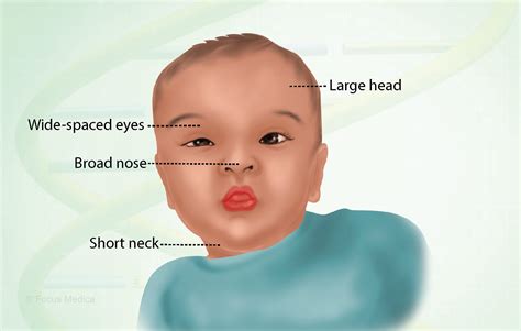 Noonan Syndrome Diagram