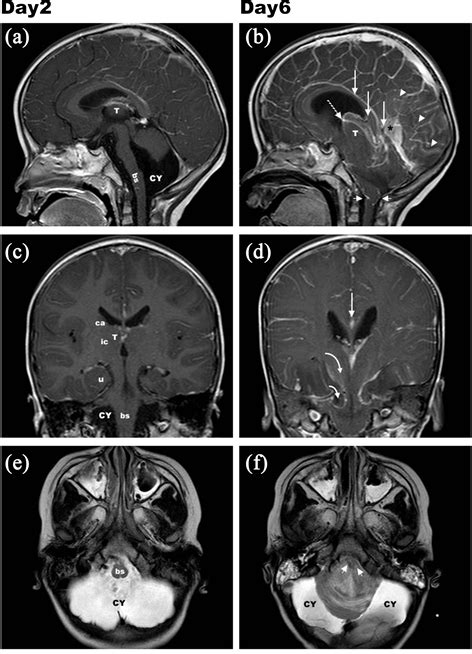 Central Brain Herniation Secondary to Influenza-Related Encephalopathy ...