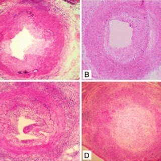 Active histological inflammatory patterns involving temporal arteries... | Download Scientific ...