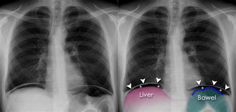 Chest X-ray Abnormalities - Diaphragmatic abnormalities