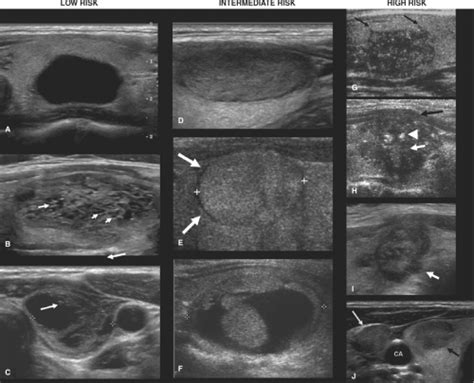 Clinical Evaluation And Management Of Thyroid Nodules Oncohema Key