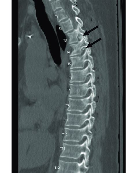 Sagittal contrast-enhanced CT myelogram of the thoracic spine... | Download Scientific Diagram