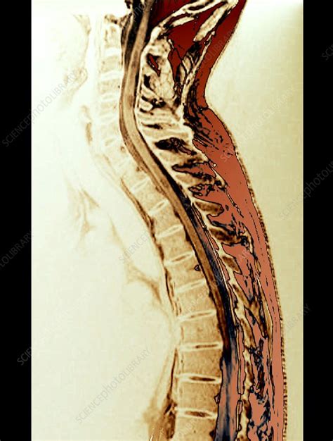 Spine in multiple sclerosis, MRI - Stock Image - C029/9907 - Science Photo Library