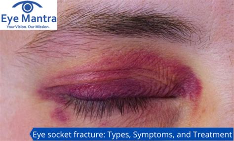 Eye Socket Fracture: Types, Symptoms, Treatment