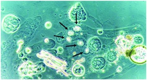 Cryptococcus neoformans encapsuled yeasts within a urinary cast. Fresh ...