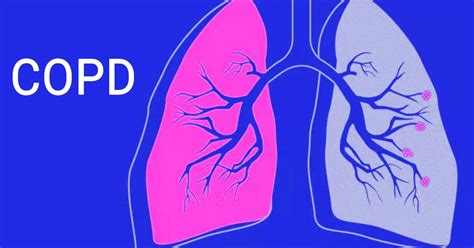 Triple drug inhaler may effectively reduce COPD exacerbations