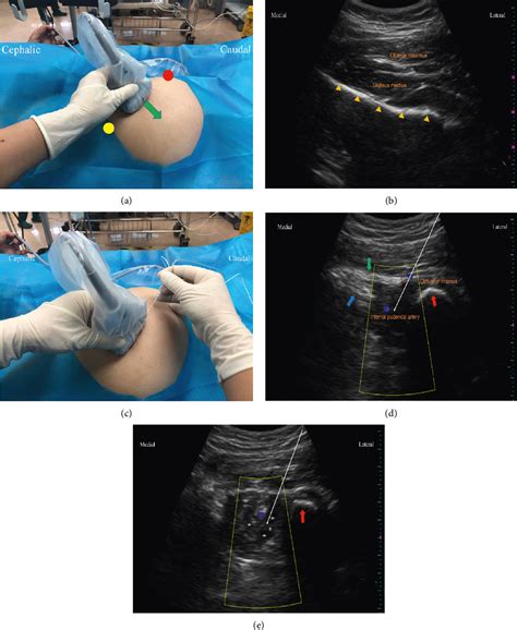 Bilateral Pudendal Nerve Block