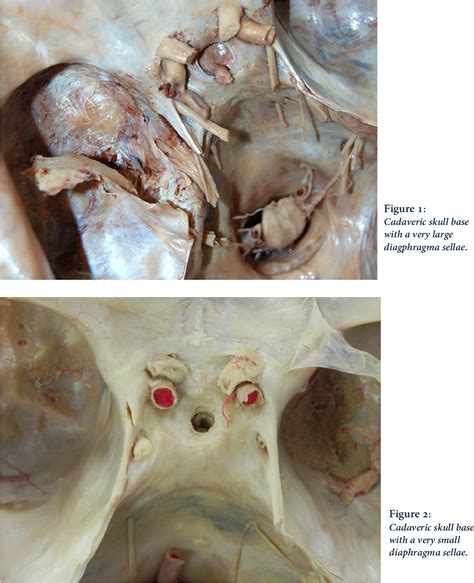 The Diaphragma Sellae: A Concise Review | Semantic Scholar