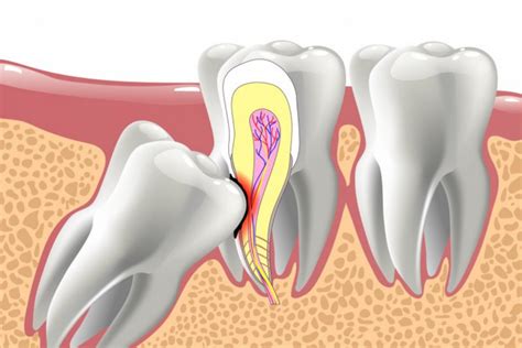 Benefits of Wisdom Teeth Removal | Peel Dental Studio Dentist Mandurah