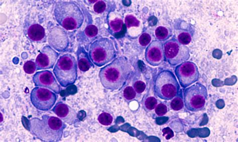 Multiple myeloma should be diagnosed by urine tests and serum assays