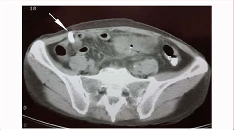 The CT scan revealed output of the contrast dye into the drainage tube... | Download Scientific ...