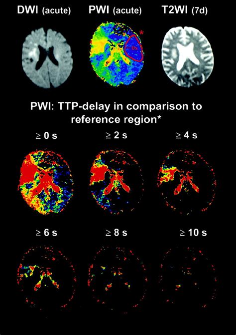 Diffusion- and Perfusion-Weighted MRI | Stroke