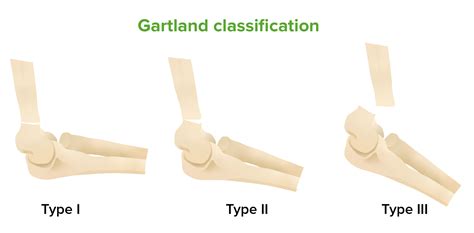 Supracondylar Fracture | Concise Medical Knowledge