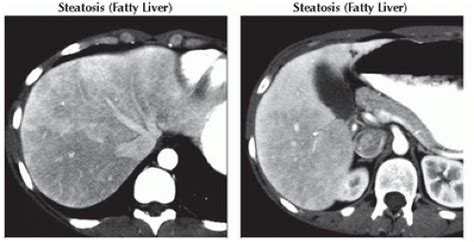 DA9-DB2-Periportal_Lucency_or_Edema-FFU11.gif | Abdominal Key