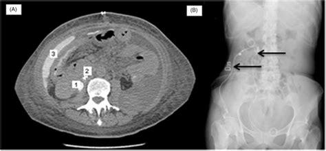 (A) Contrast-enhanced abdominal CT-Scan: urine dye present in... | Download Scientific Diagram