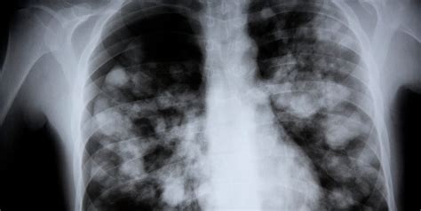 What Is White Lung Syndrome? Signs, Symptoms, and Treatment Options