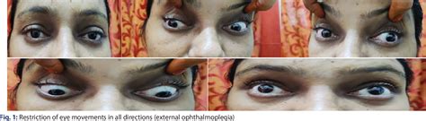 Figure 1 from Sensory Ataxic Neuropathy with Dysarthria and Ophthalmoplegia (SANDO): A ...