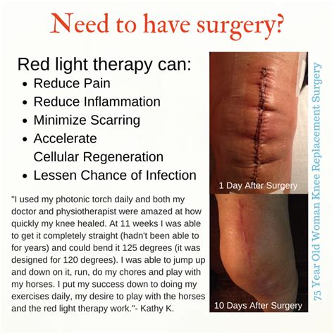 Red Light therapy applied to 10-day-old knee replacement surgical scar ...