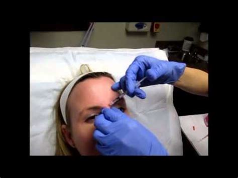 Xeomin Treatment Forehead Wrinkles and Lines Between Eyes - YouTube