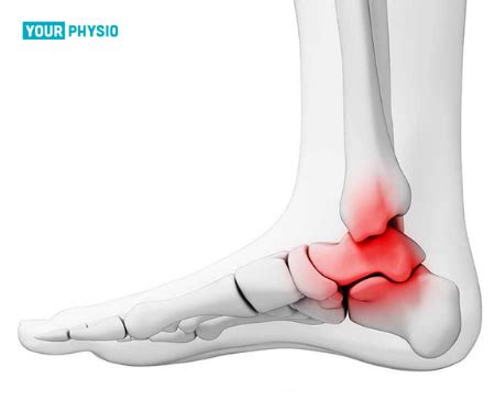 Subtalar Arthritis: Causes, Treatment, Physiotherapy & More