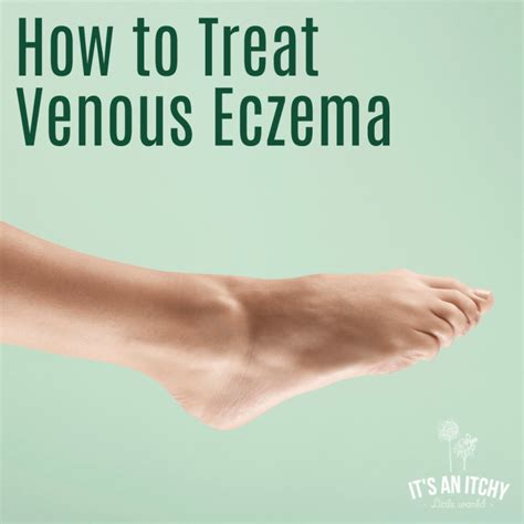 venous eczema treatment - itchylittleworld.com