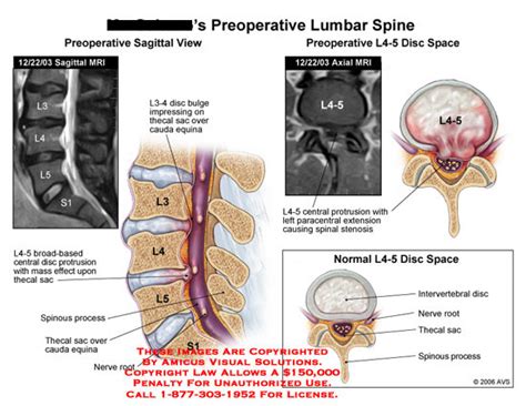 AMICUS Illustration of amicus,radiology,lumbar,spine,MRI,sagittal,axial ...