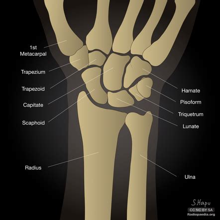 Carpal bones | Radiology Reference Article | Radiopaedia.org