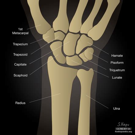 Dorsal and volar intercalated segmental instability and normal carpal ...