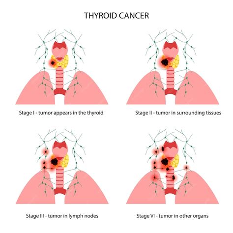 Premium Vector | Thyroid cancer stages