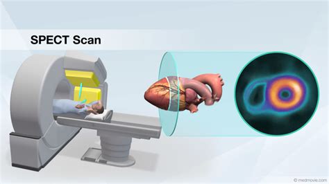 SPECT Scan Image – Medmovie.com