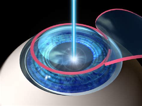 What is Laser Eye Surgery? - Lasik Eye Surgery Hawaii | Laser Eye ...