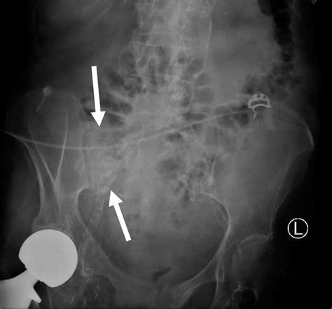 Percutaneous Sacroplasty for Sacral Insufficiency Fractures: Case Series and Review of ...