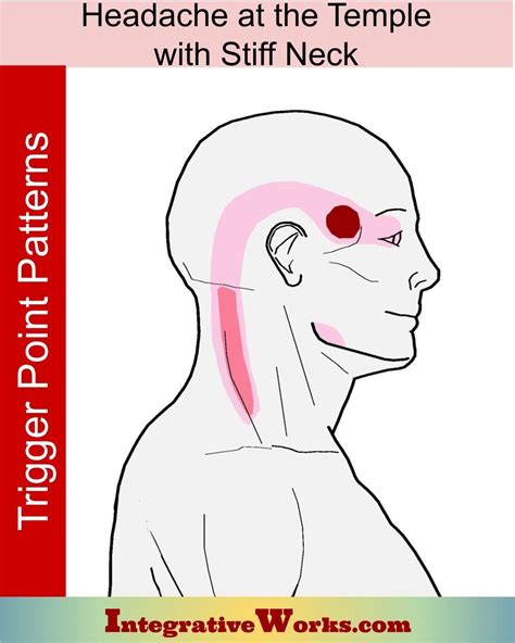 Headache At Your Temple with Stiff Neck - Integrative Works | Stiff neck, Neck headache, Neck pain