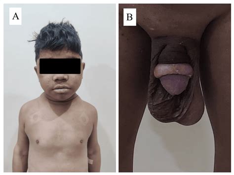 Uncovering Congenital Hypothyroidism in Adulthood: A Case Study Emphasizing the Urgency of ...