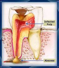 Tay Dental Surgery | Tooth Pulp Disease