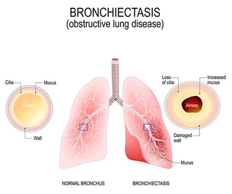 Coping with Airway Mucus | Bronchiectasis and NTM Initiative