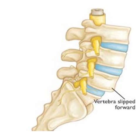 Image Gallery Lumbar Anterolisthesis