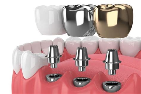 Tips To Care For Your Dental Implants | Dental implants, Dental, Dental care